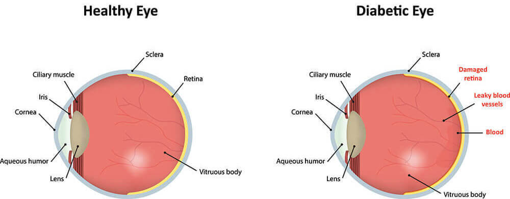 Chart Illustrating a Healthy Eye Compared to a Diabetic Eye