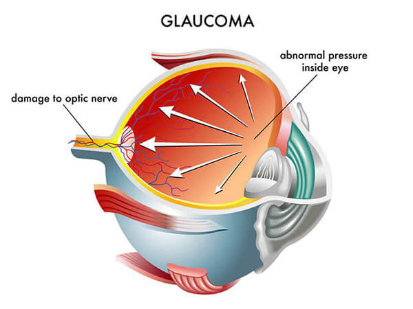 Chart Illustrating How Glaucoma Affects an Eye